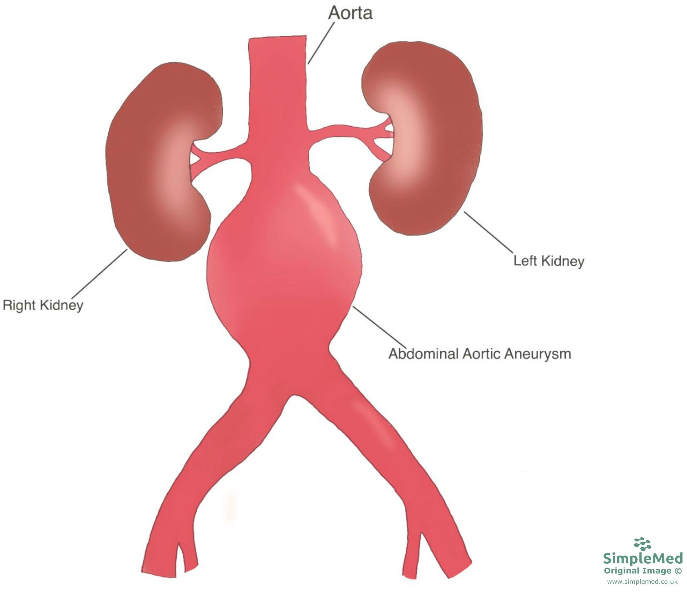 Abdominal Aortic Aneurysm Diagram SimpleMed