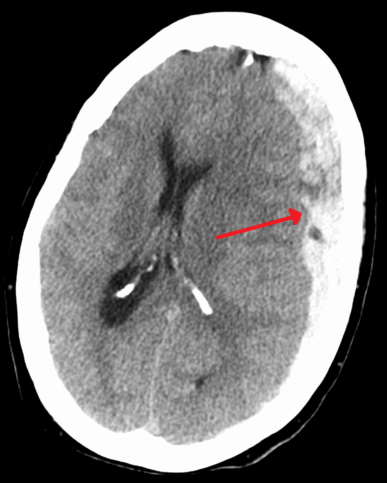 Acute Subdural Haematoma SimpleMed