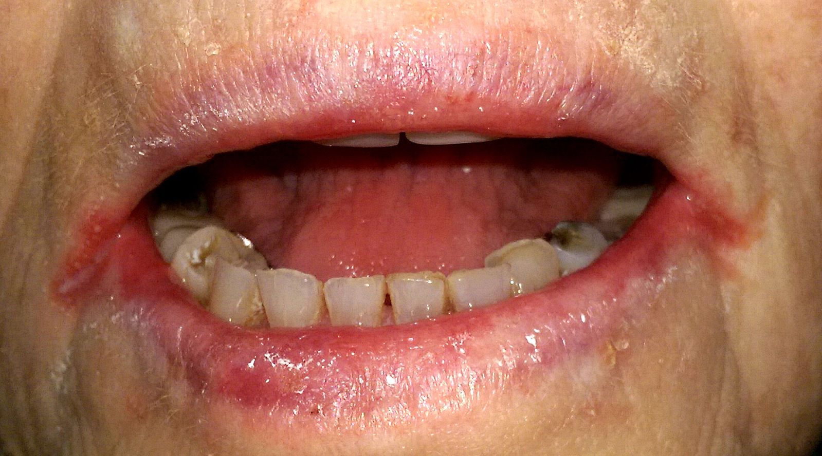 Angular Stomatitis SimpleMed