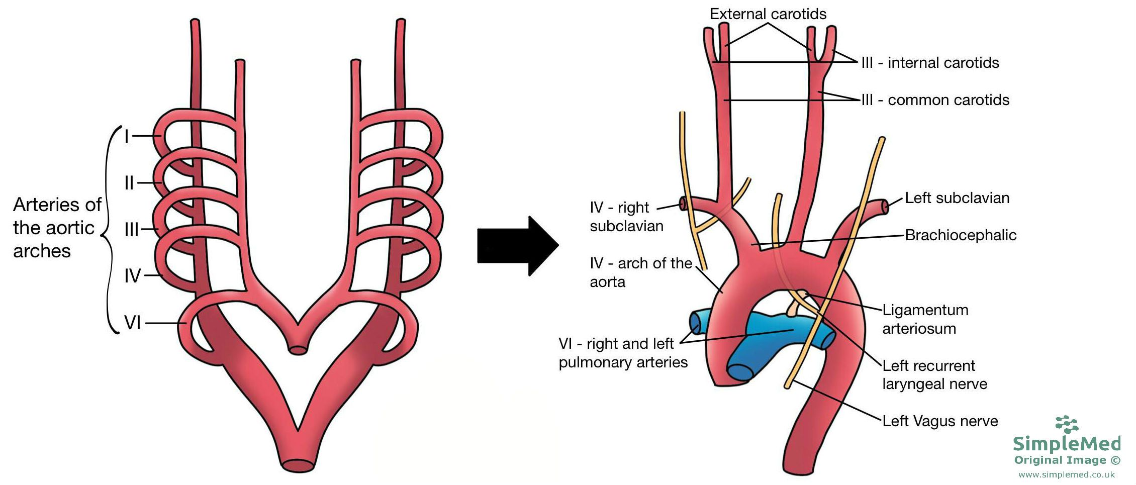 Aortic Arches SimpleMed