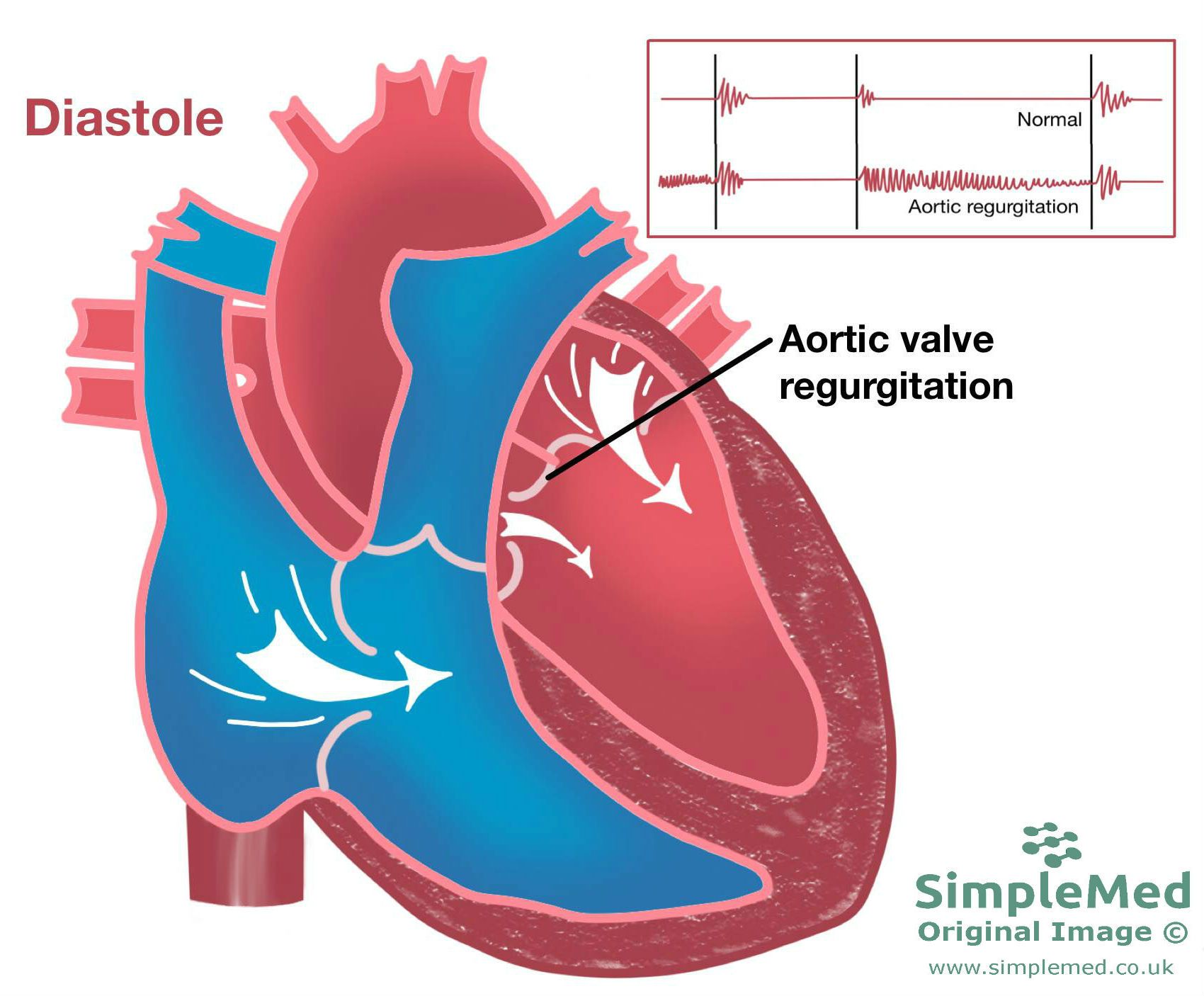 Aortic Valve Regurgitation SimpleMed