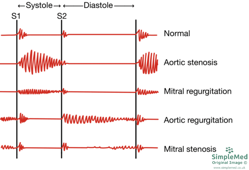 Heart Valve Auscultation Sounds SimpleMed