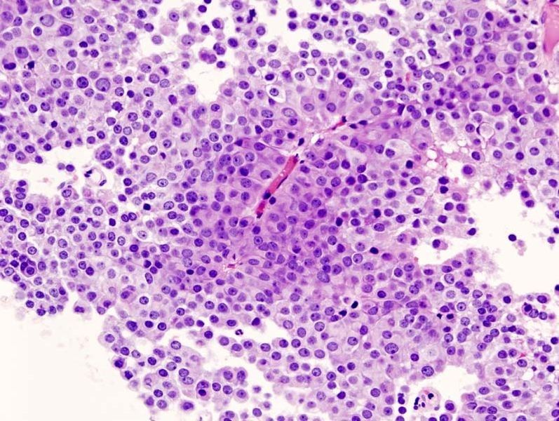 Benign neoplasm histology SimpleMed