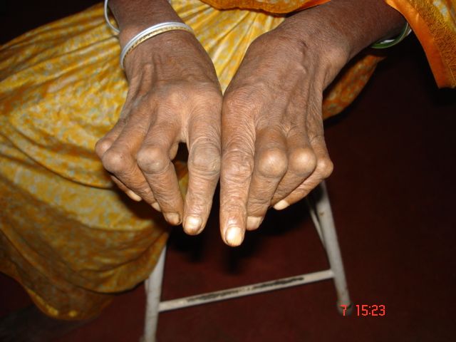 Boutonniere Deformity SimpleMed