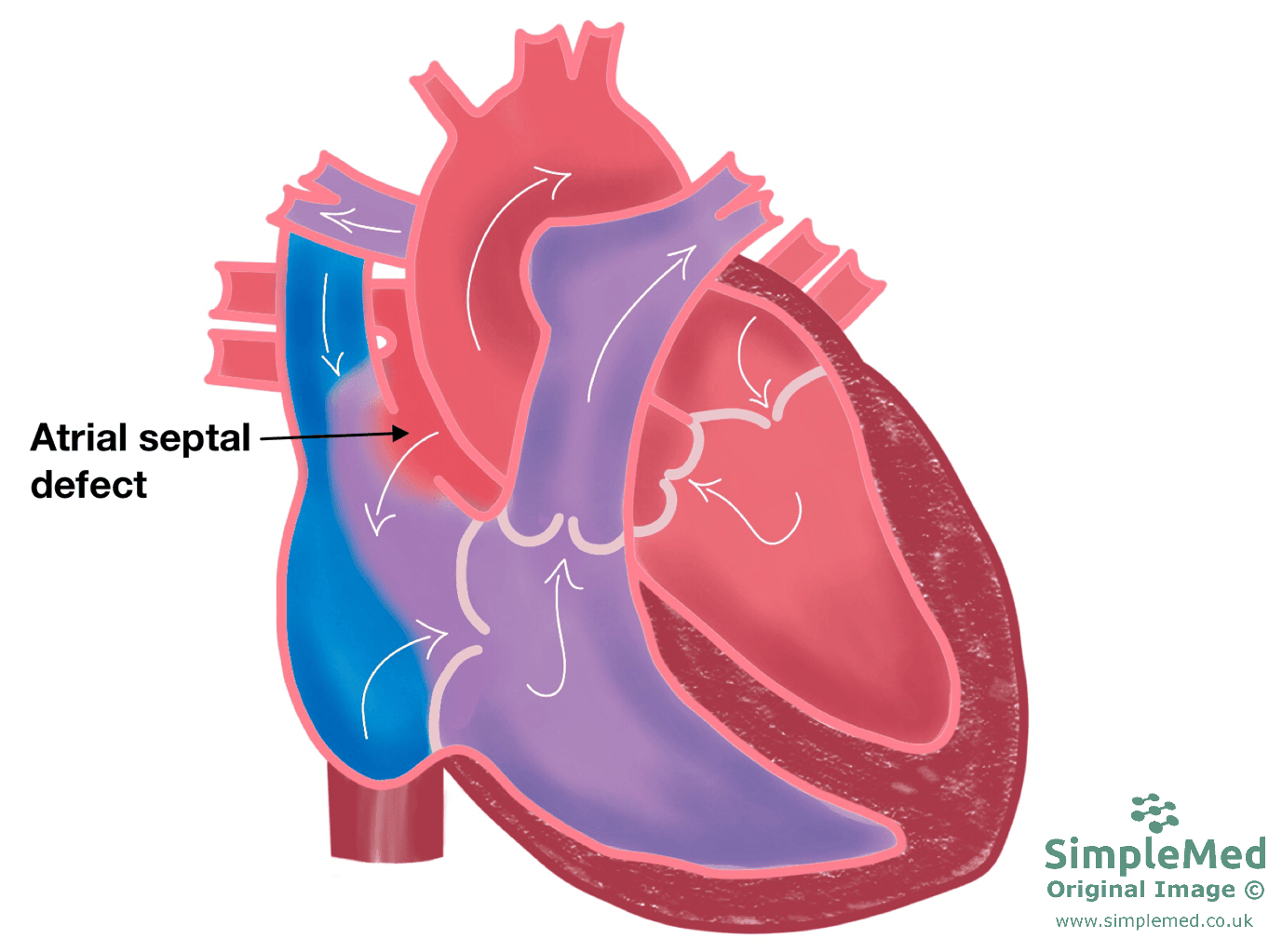 Atrial Septal Defect SimpleMed