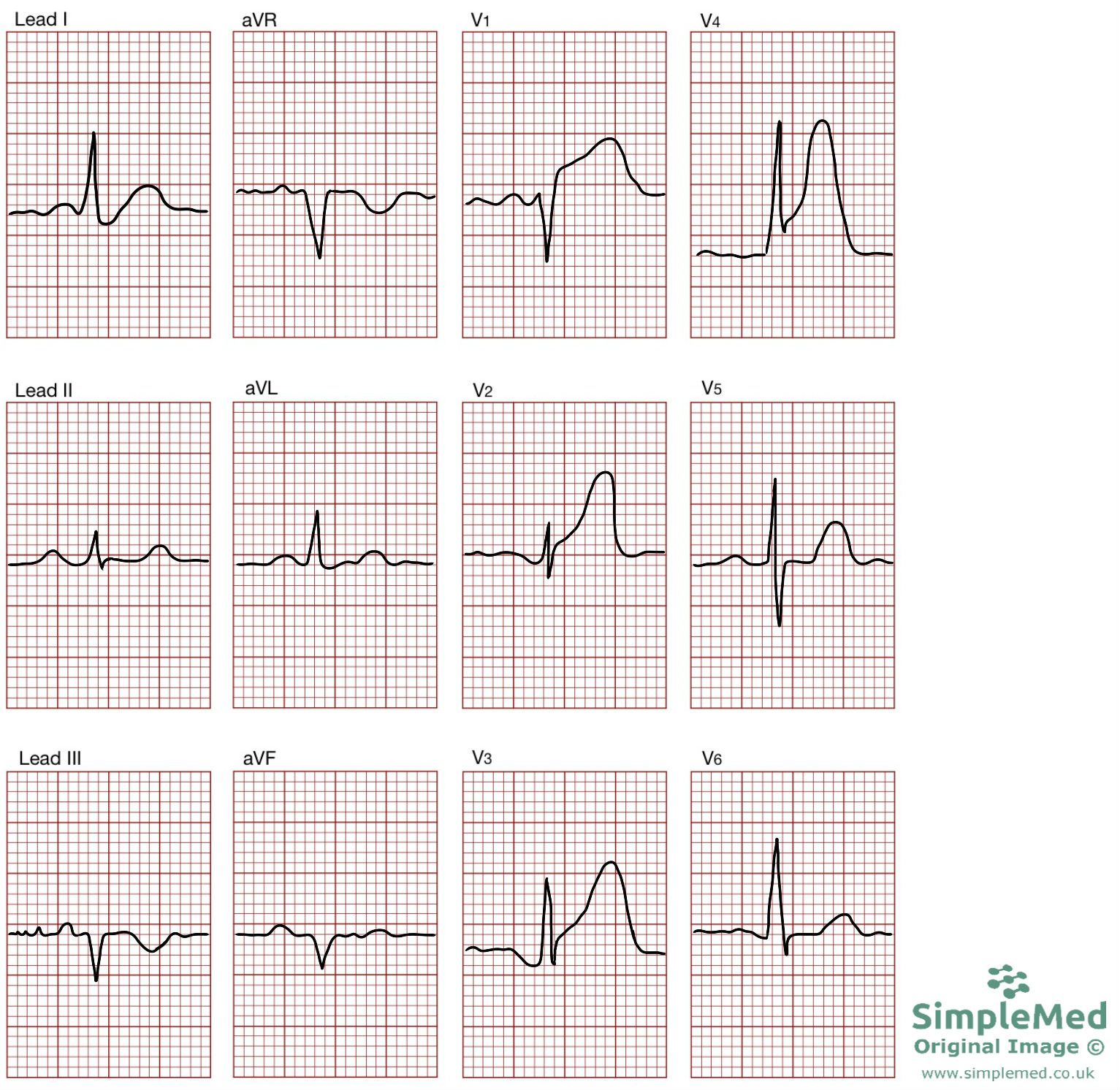 12 Lead ECG of a STEMI SimpleMed