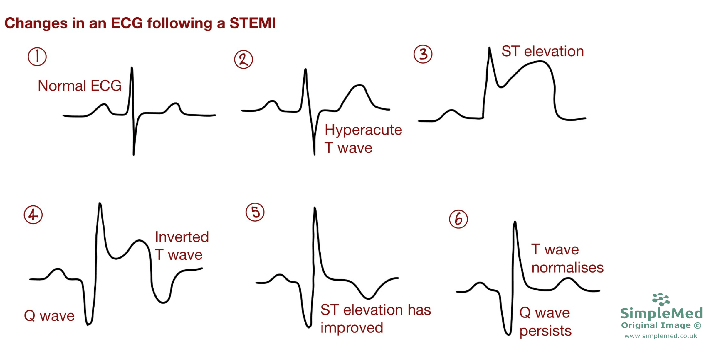 ECG changes in a STEMI SimpleMed