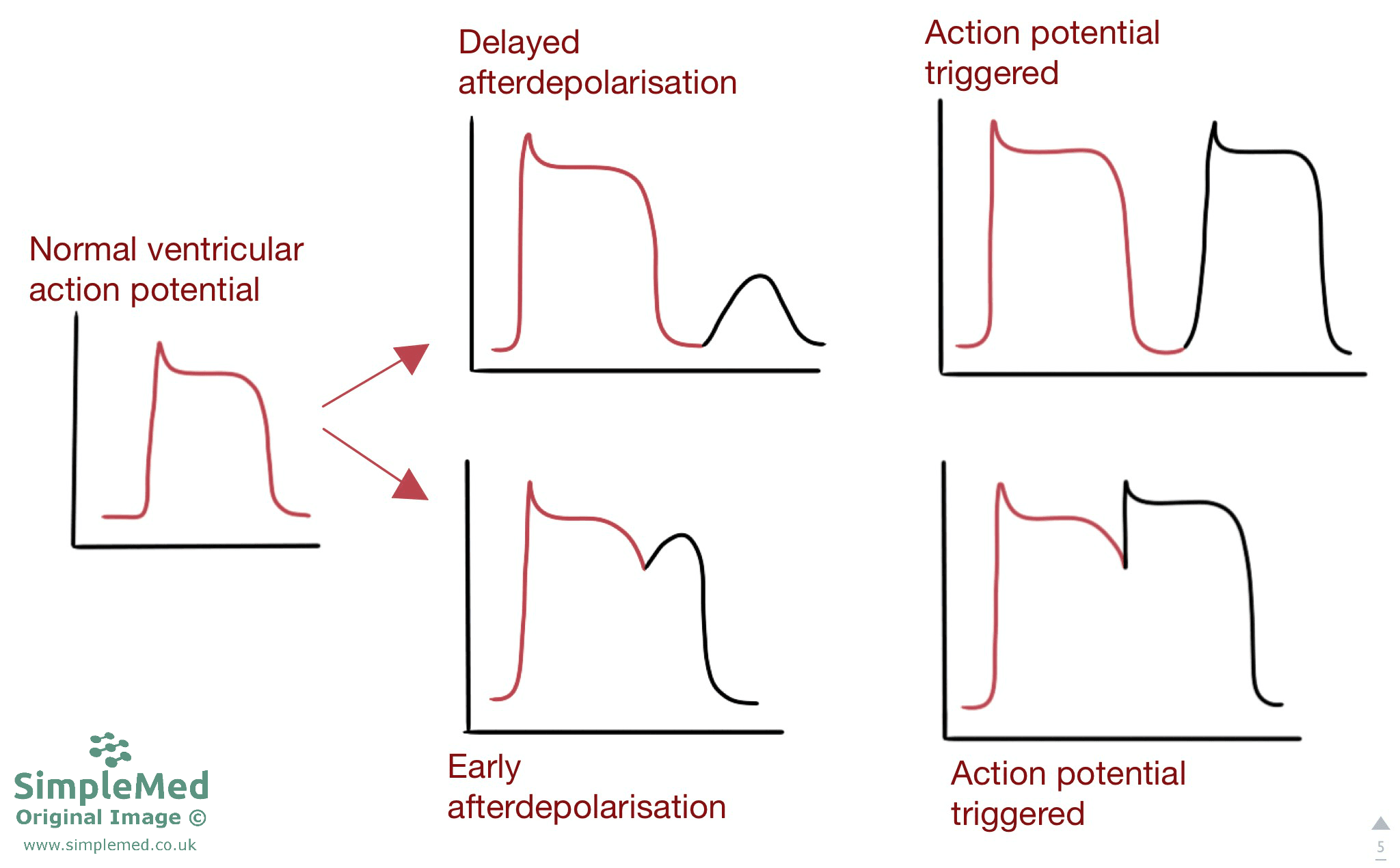 Early and Delayed Afterdepolarisations ECG SimpleMed