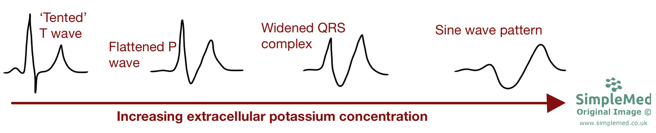 Hyperkalaemia ECG changes SimpleMed