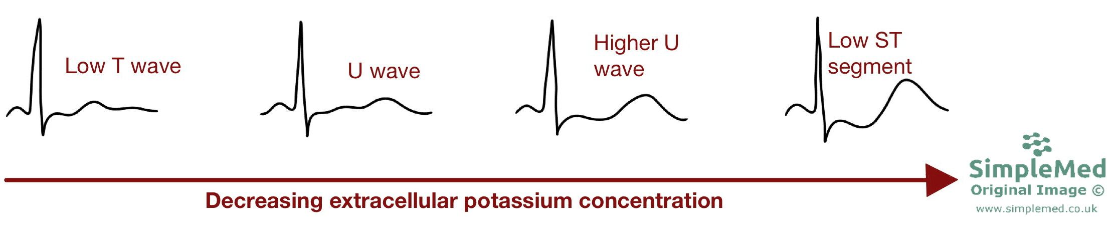 Hypokalaemia ECG changes SimpleMed