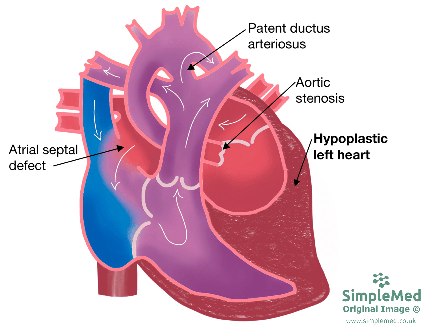 Hypoplastic Left Heart SimpleMed