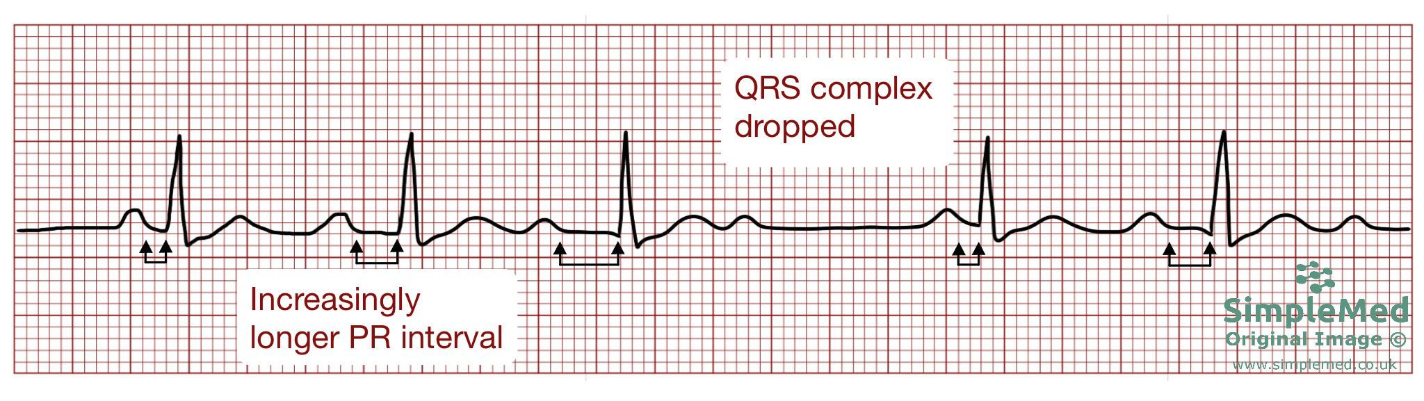 Second degree heart block Mobitz type 1 ECG SimpleMed