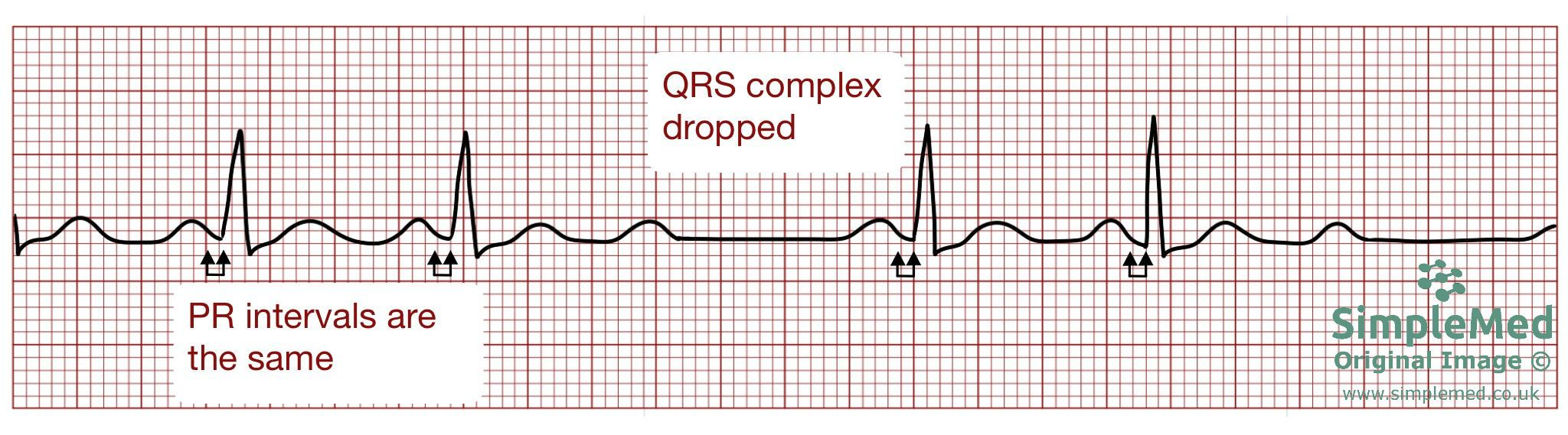 Second degree Mobitz Type 2 ECG SimpleMed