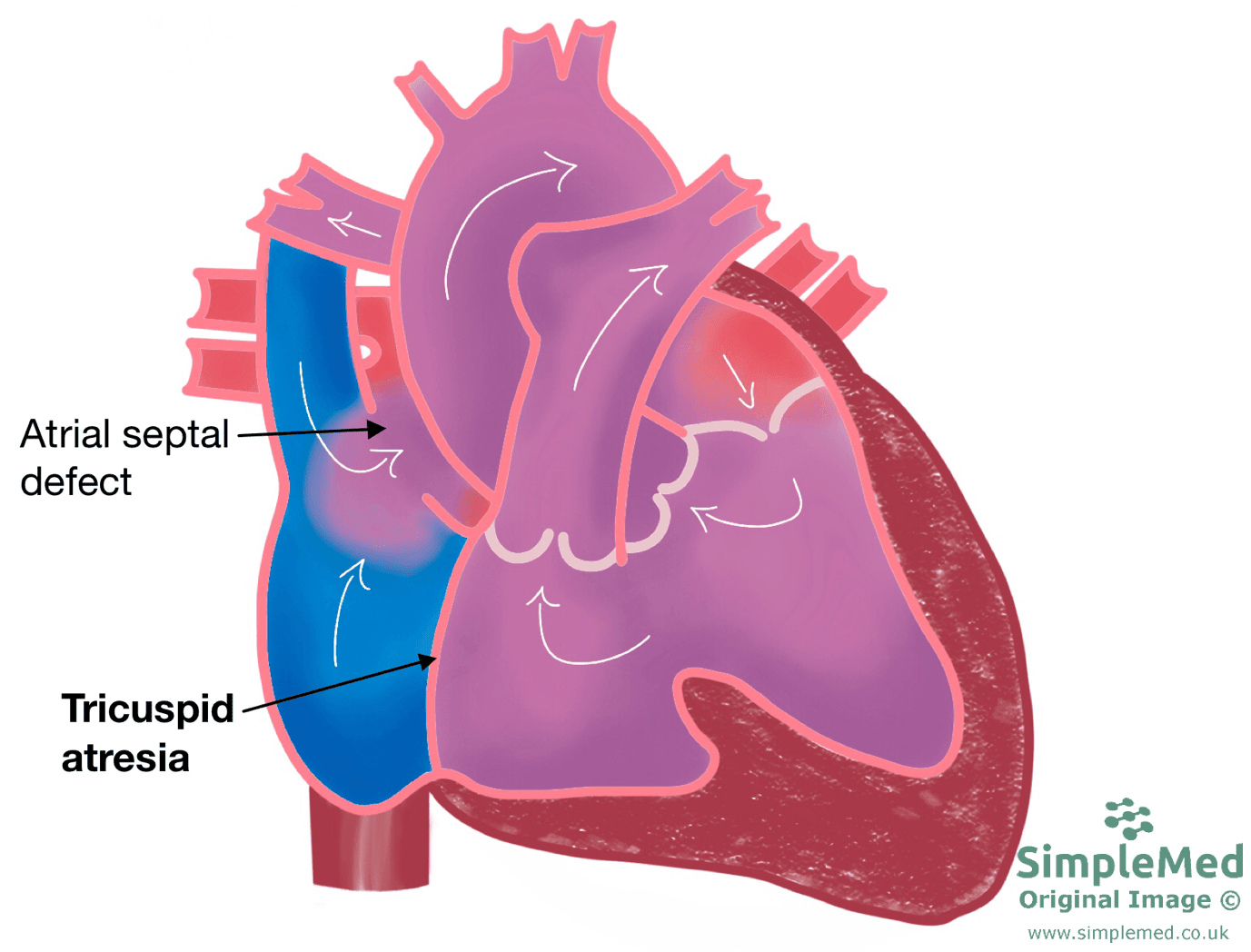 Tricuspid Atresia SimpleMed