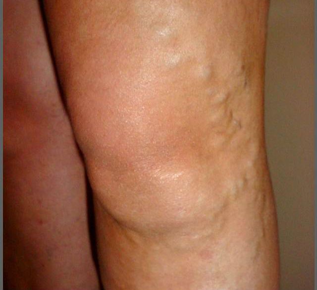 Varicose Veins SimpleMed