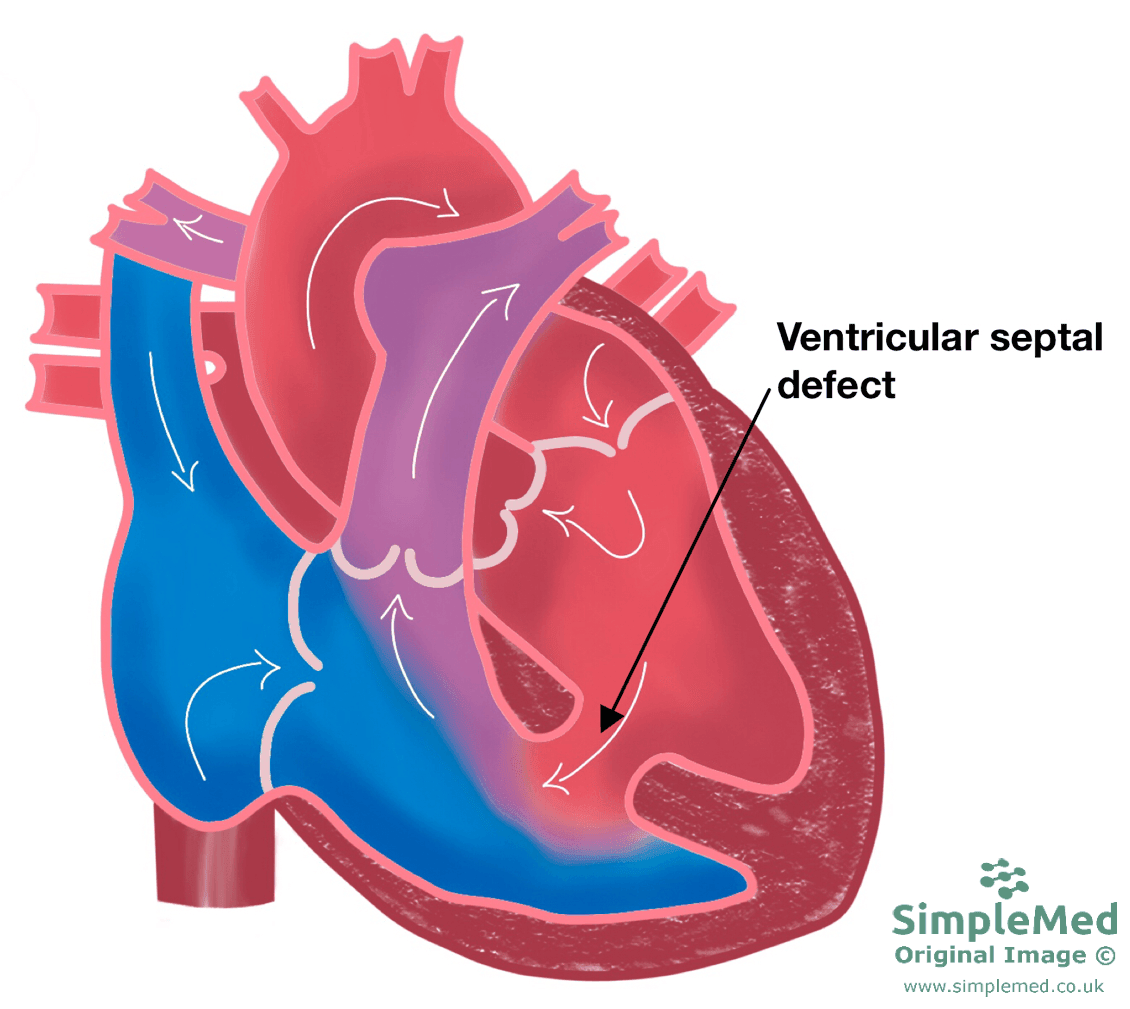 Ventricular Septal Defect SimpleMed