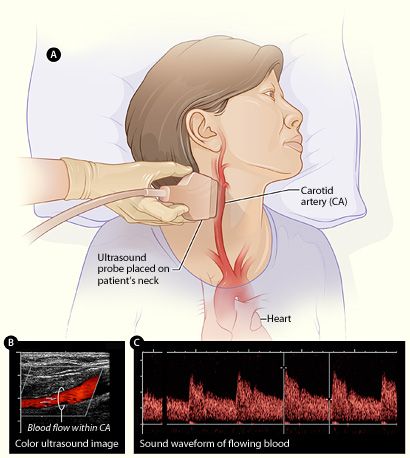 Carotid Doppler Ultrasound Scan SimpleMed