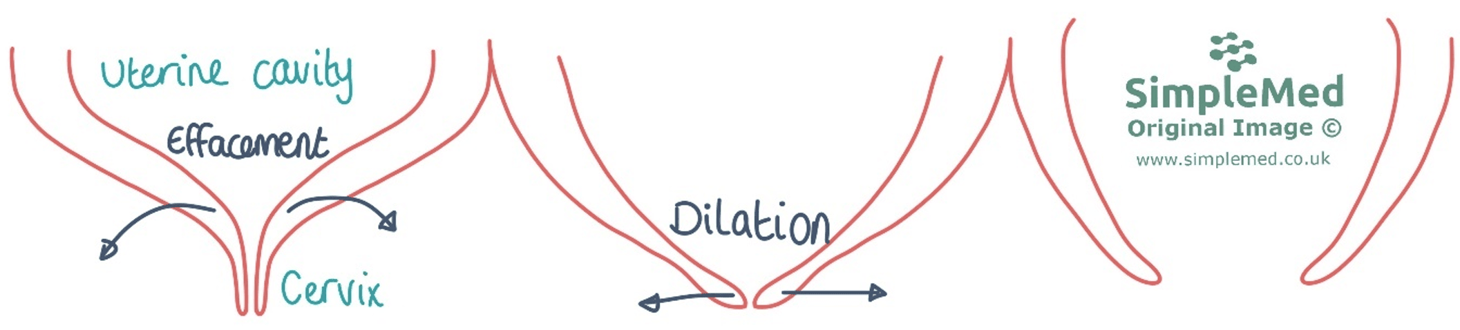 Cervical Effacement and Dilation SimpleMed