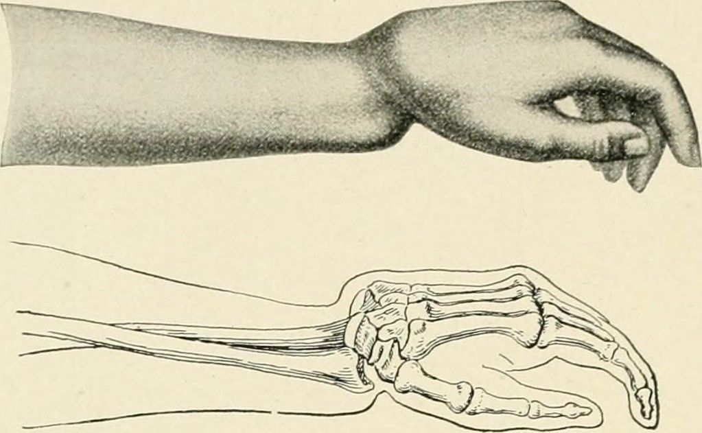 Colle's Fracture SimpleMed