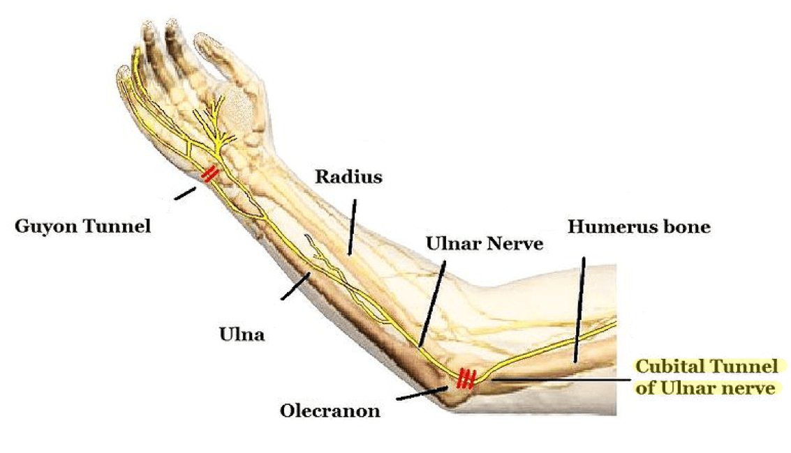 Cubital Tunnel Diagram SimpleMed