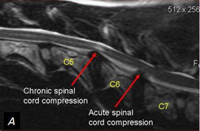 Cervical Myelopathy SimpleMed