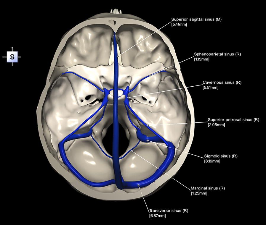 Dural Venous Sinuses SimpleMed