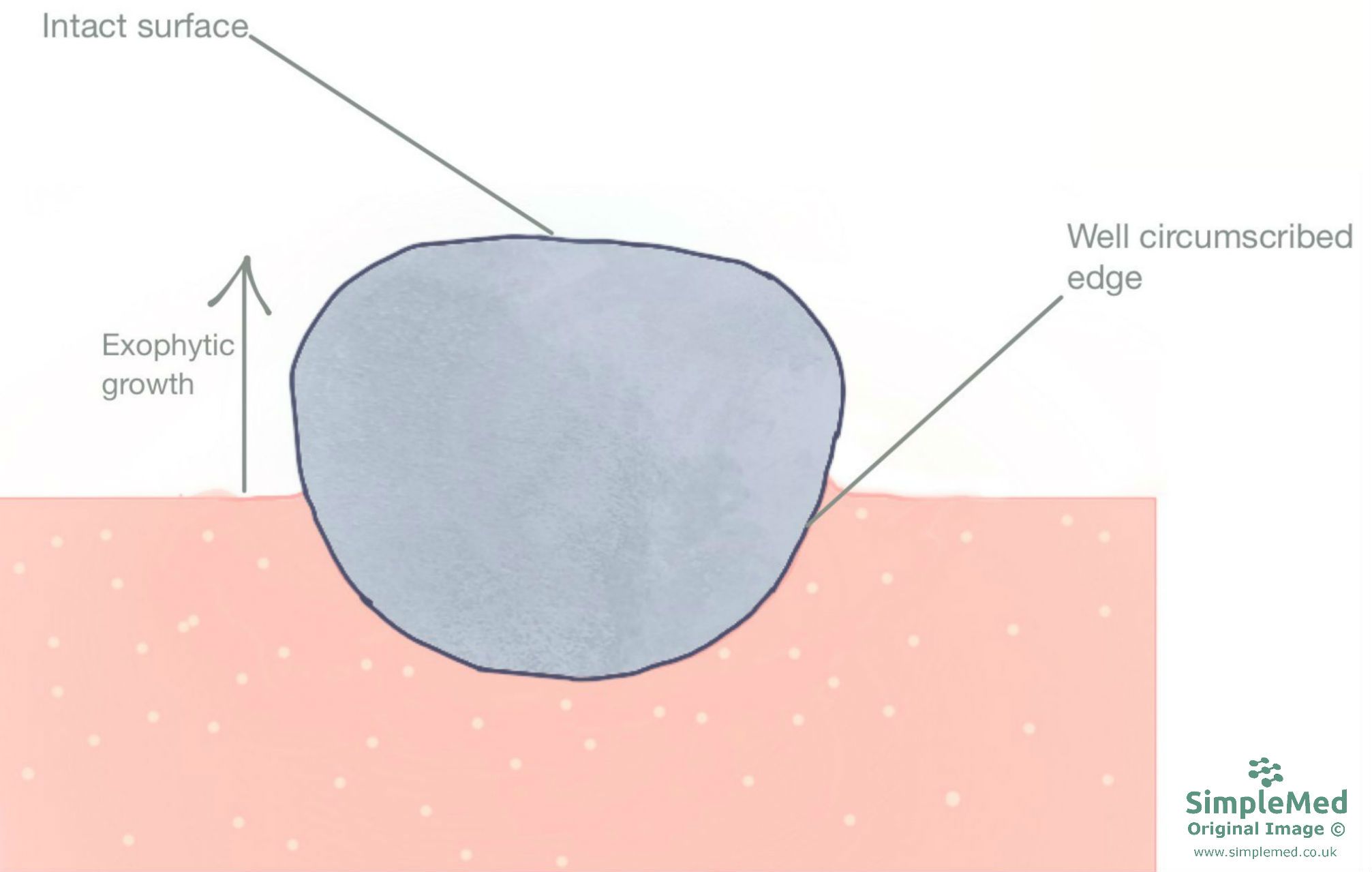 Exophytic Growth SimpleMed