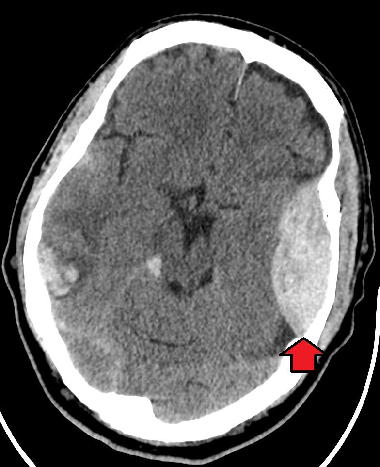 Extradual Haemorrhage CT Scan SimpleMed