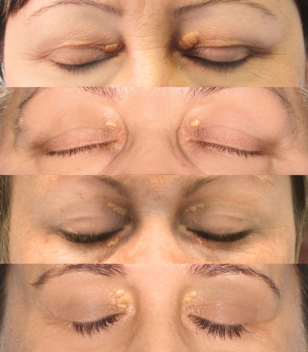 Eyelid Xanthelasma SimpleMed