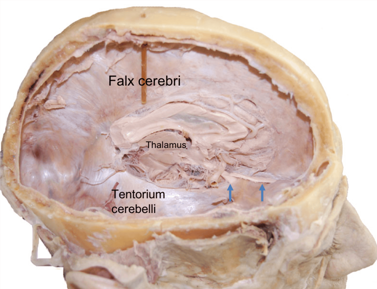 Falx Cerebri and Tentorium Cerebelli Prosection SimpleMed