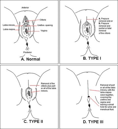 Female Genital Mutilation SimpleMed