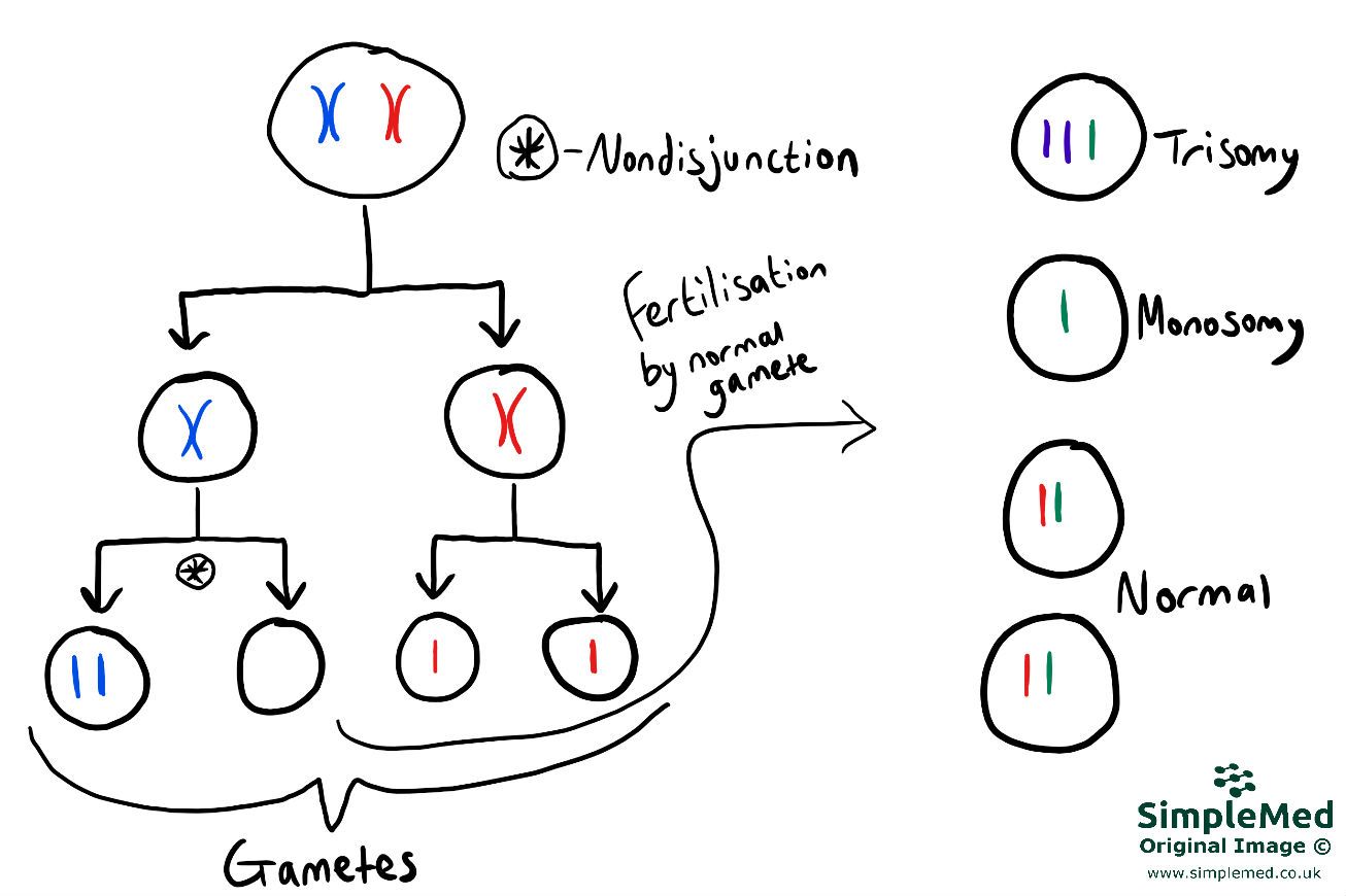 Non-disjunction in Meiosis 2 SimpleMed