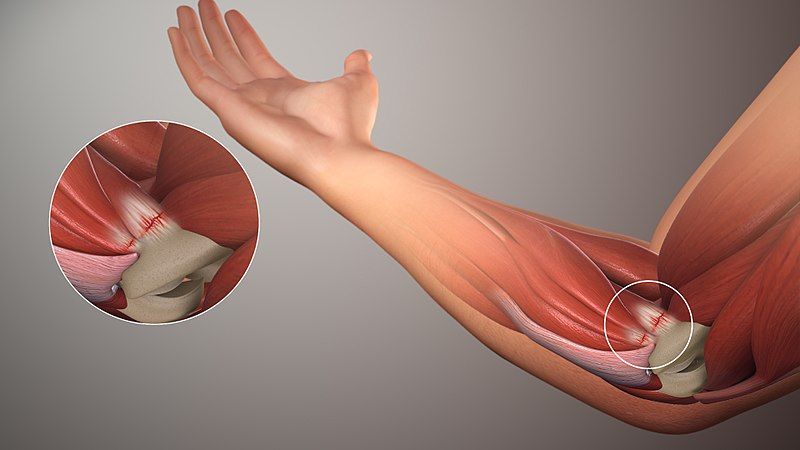 Golfers Elbow/Medial Elbow Tendinopathy SimpleMed