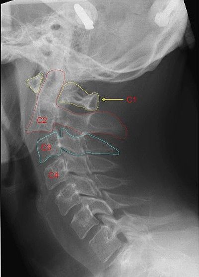 Hangmans Fracture SimpleMed