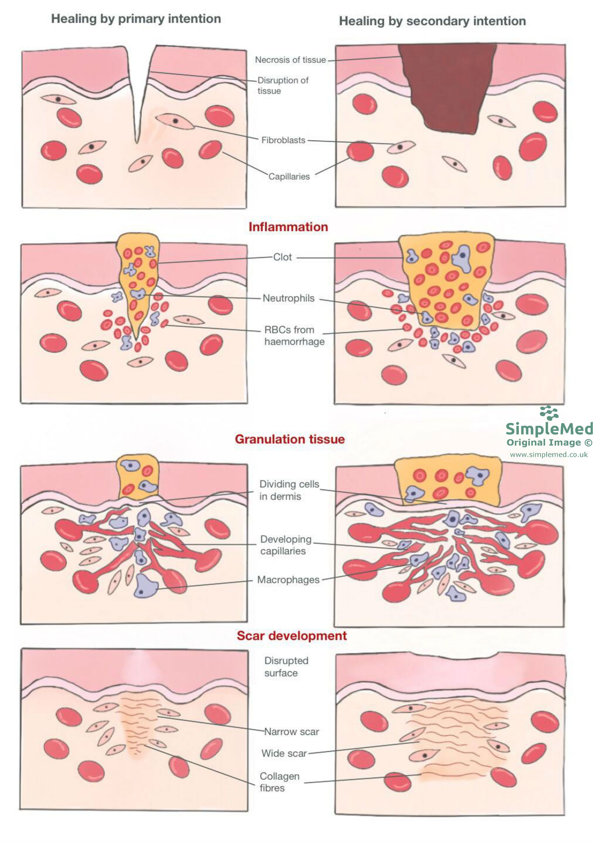 Healing by Primary and Secondary Intention SimpleMed