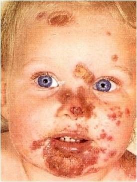 Impetigo SimpleMed