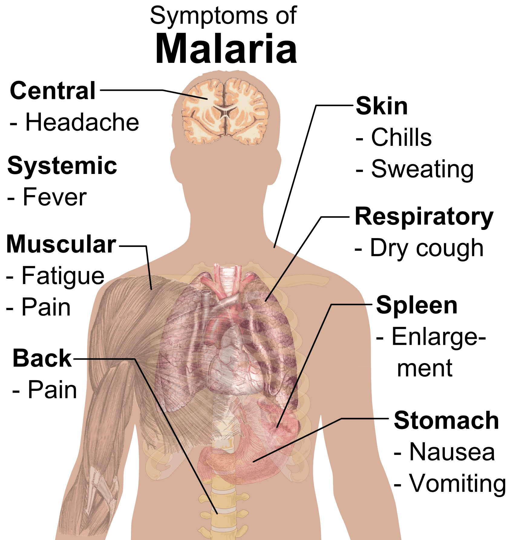 Symptoms of Malaria SimpleMed