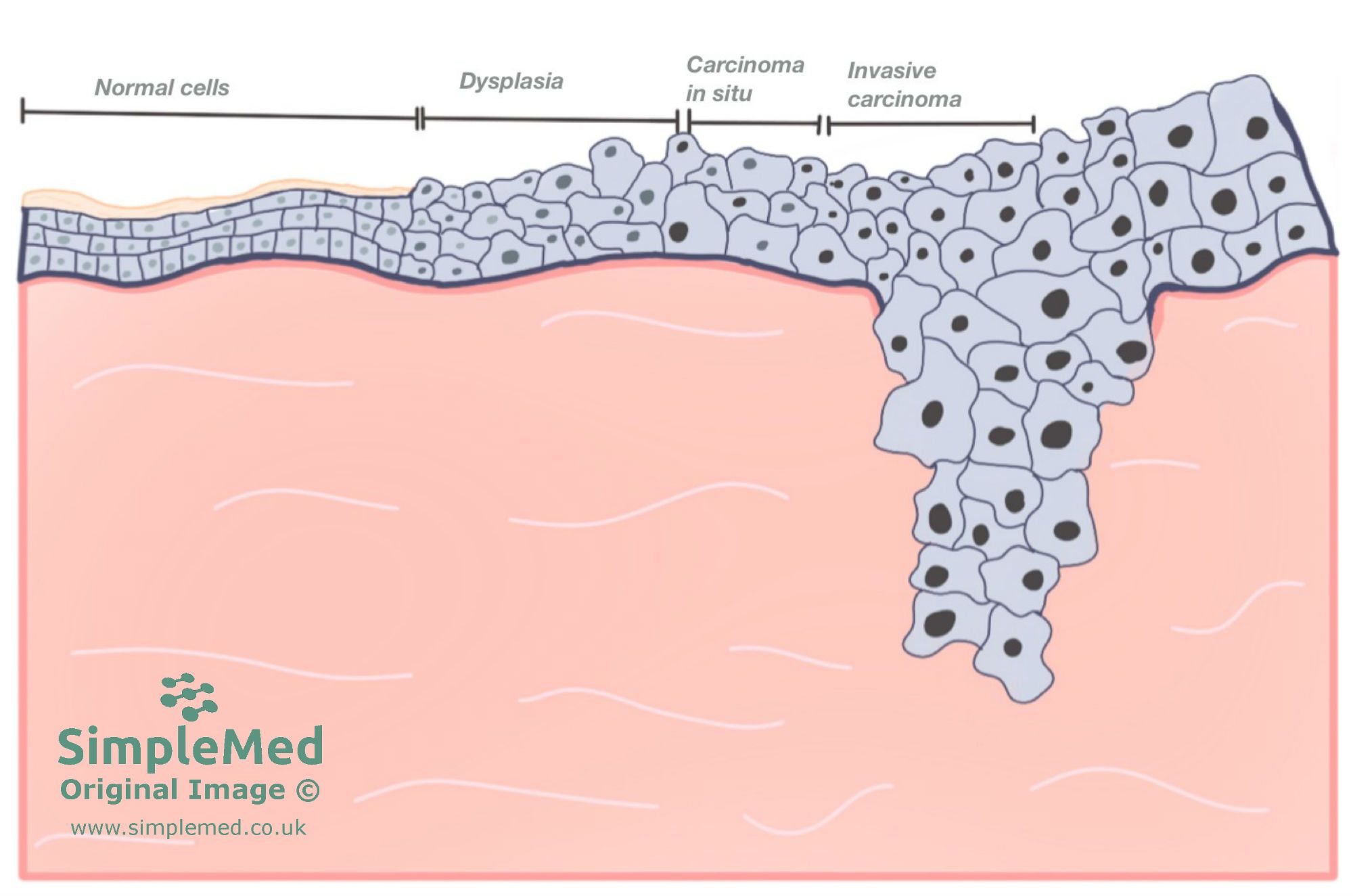 Invasive carcinoma progression SimpleMed