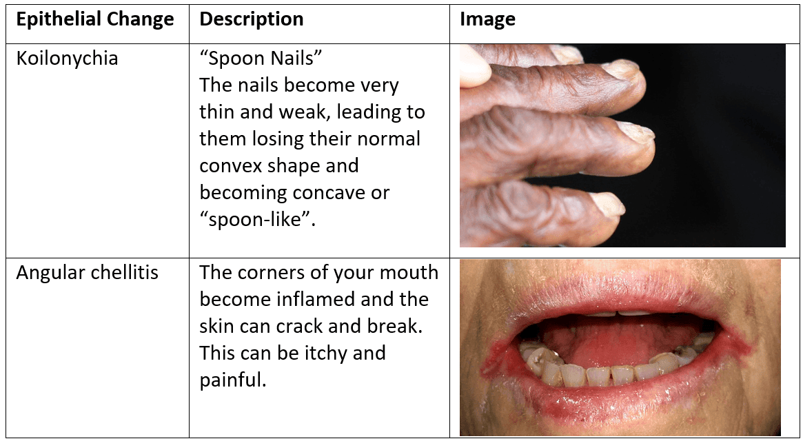 Koilonychia and Angular Chellitis SimpleMed