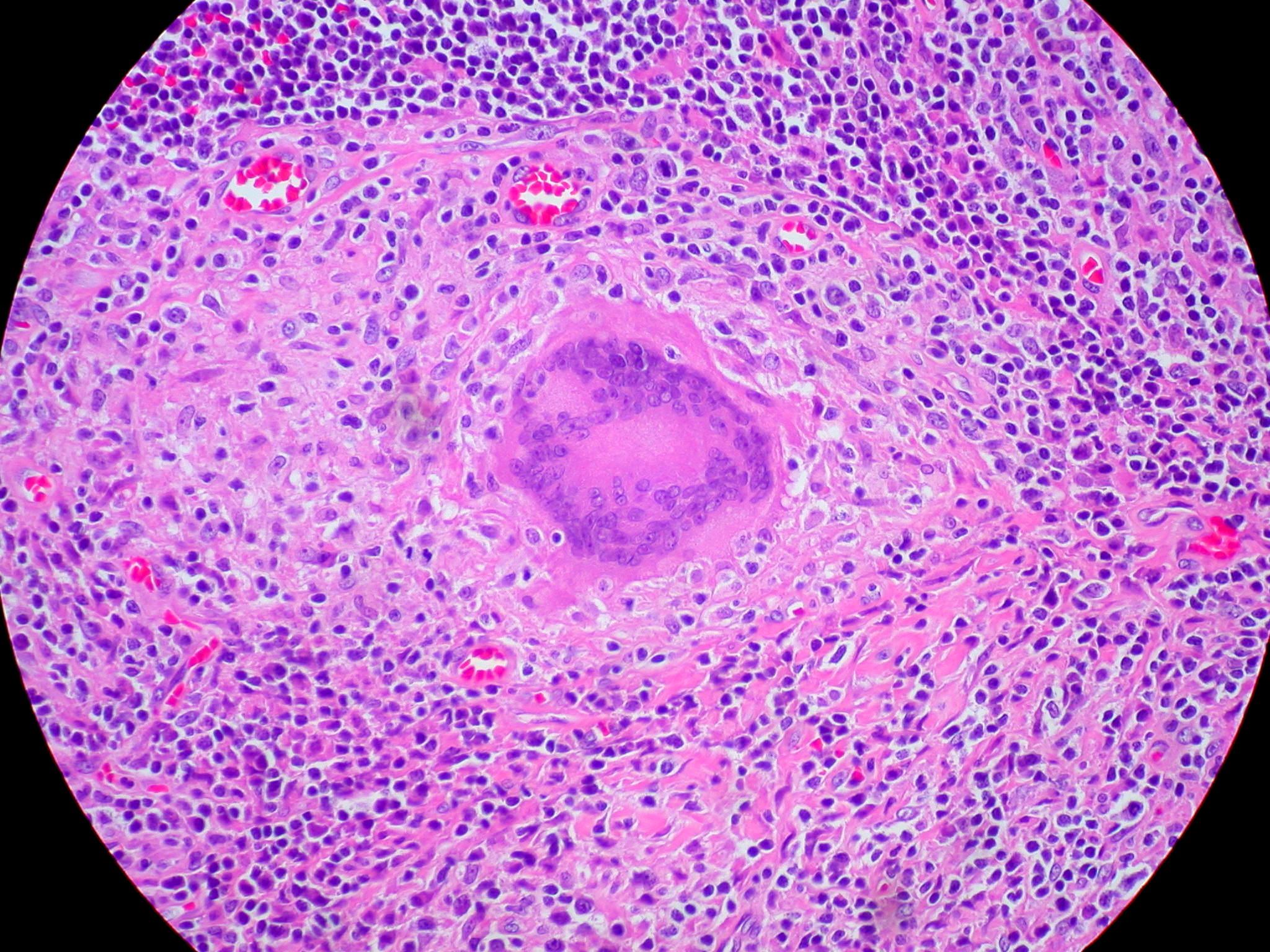 Langhans Giant Cell Histology SimpleMed