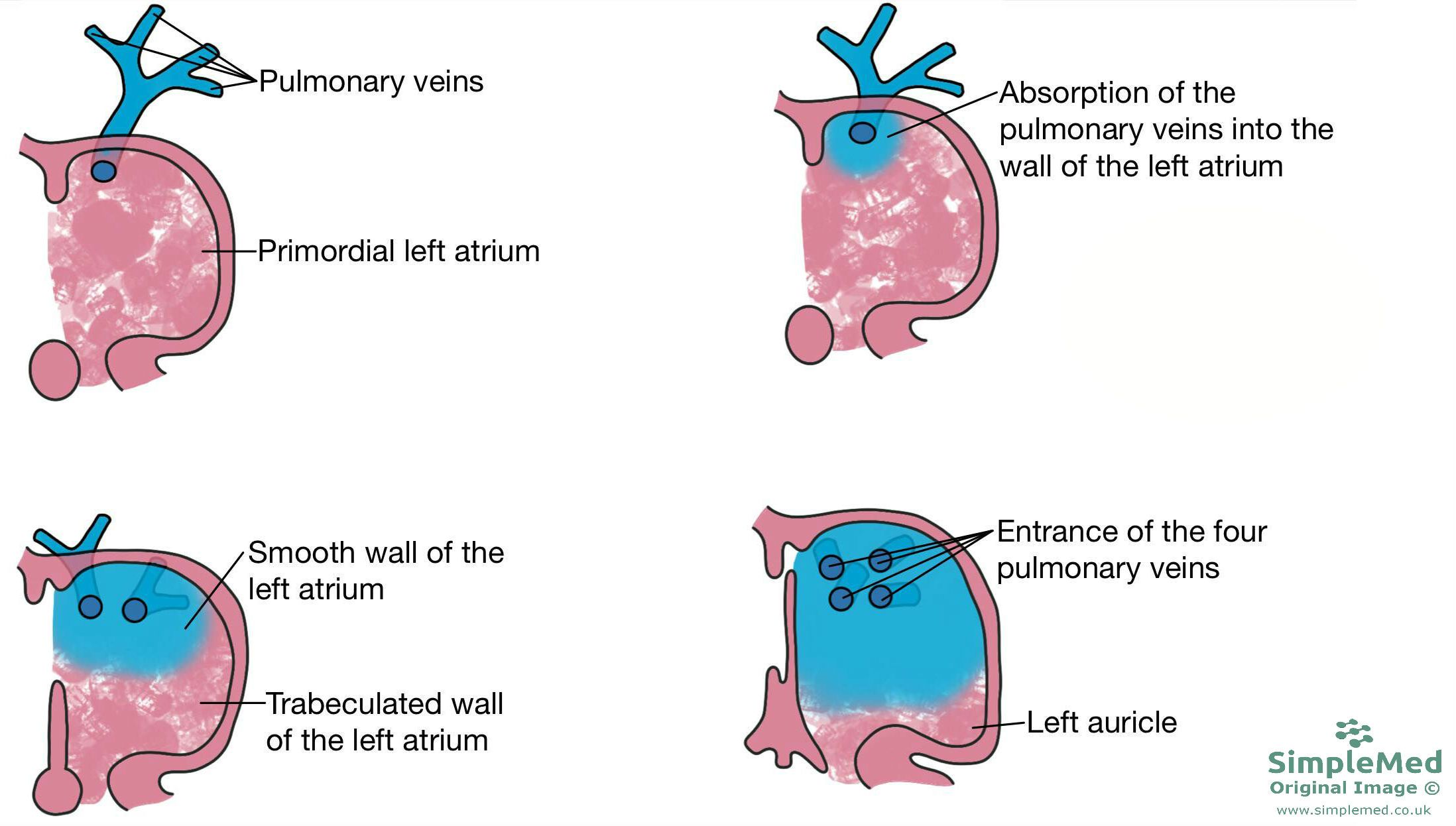 Left Atria Formation SimpleMed