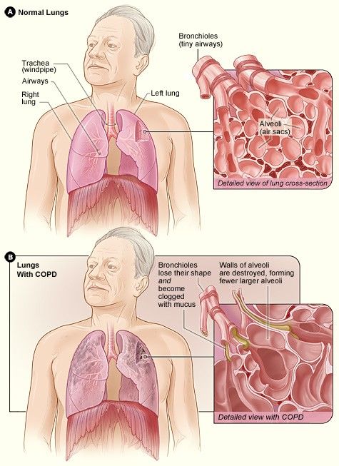 Lungs with COPD vs Lungs without COPD SimpleMed