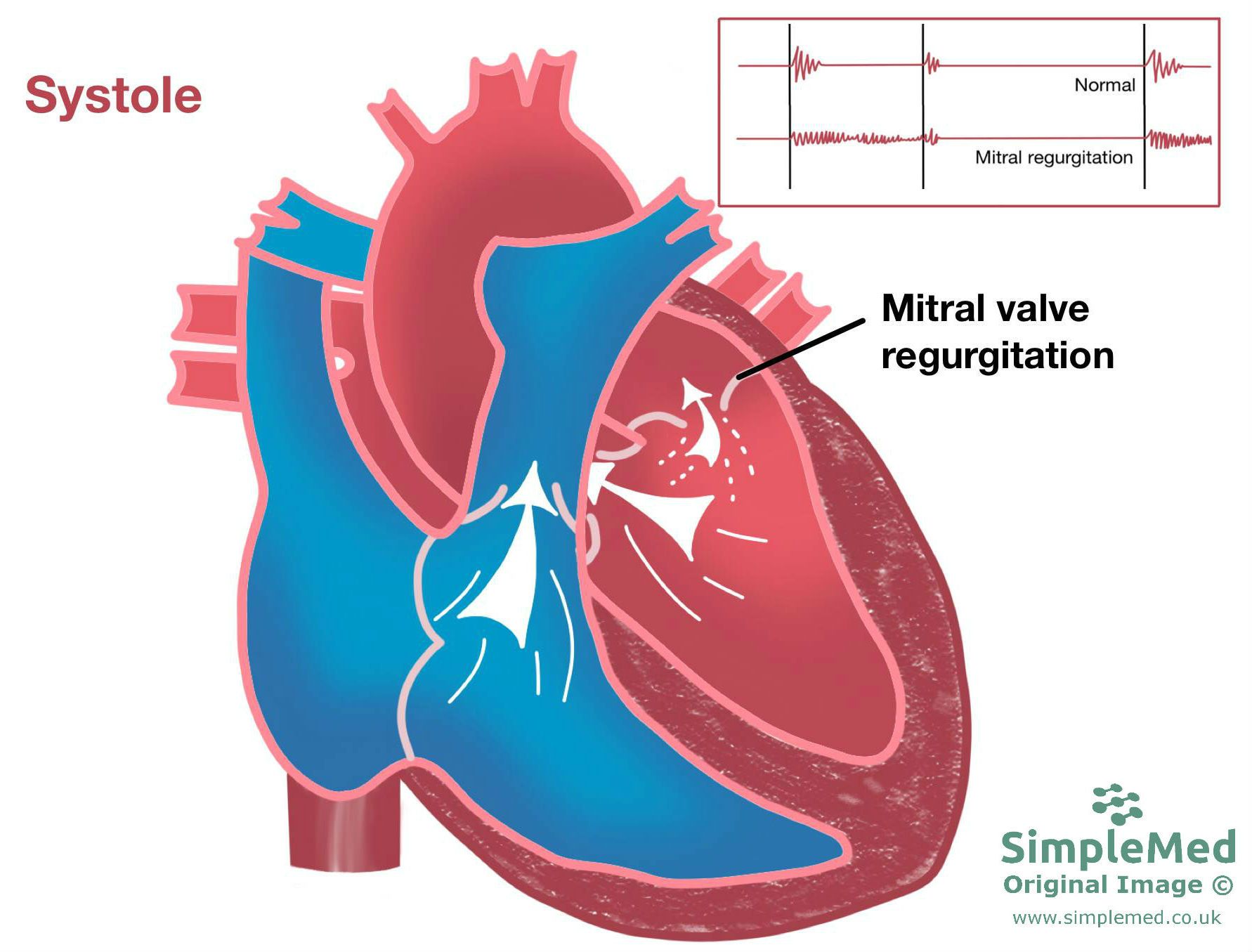 Mitral Valve Regurgitation SimpleMed