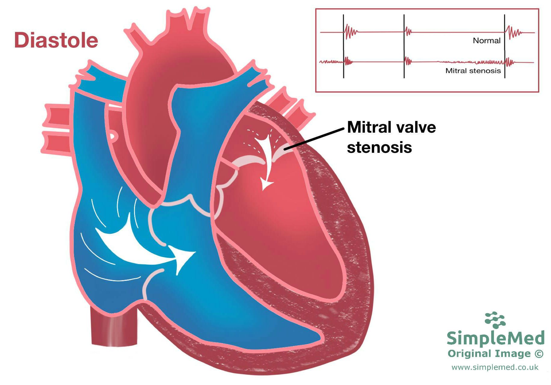 Mitral Valve Stenosis SimpleMed