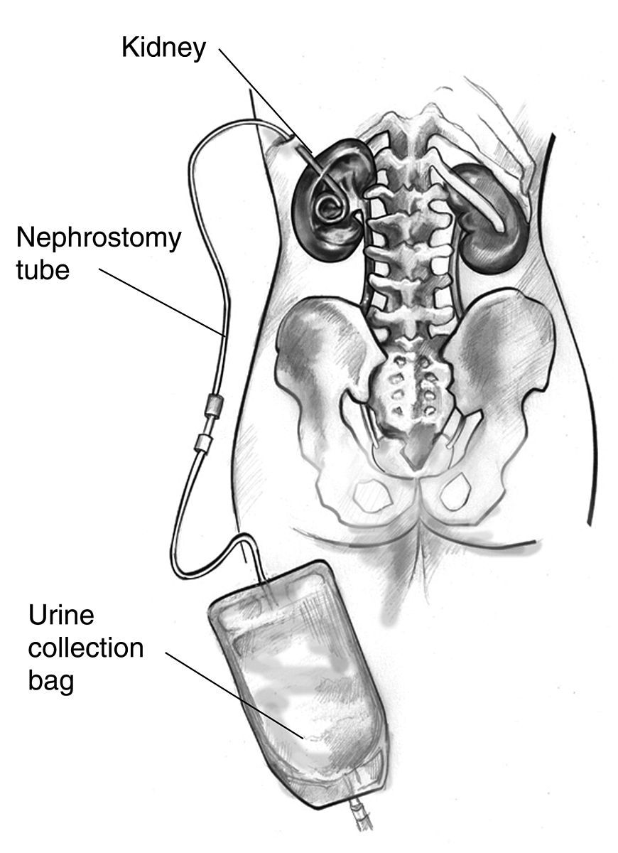 Nephrostomy Tube SimpleMed