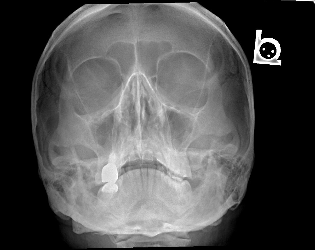 Occipitomental Projection of the Skull SimpleMed