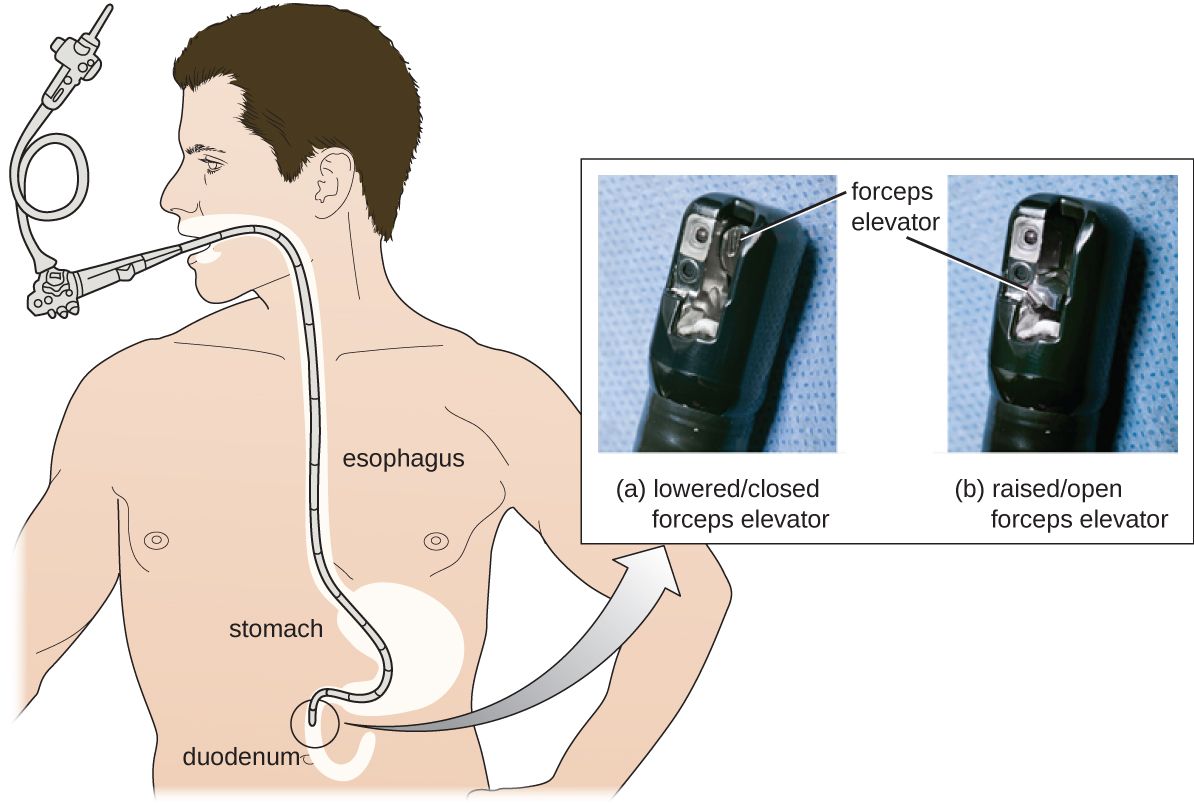 Oesophagogastroduodenoscopy Process SimpleMed