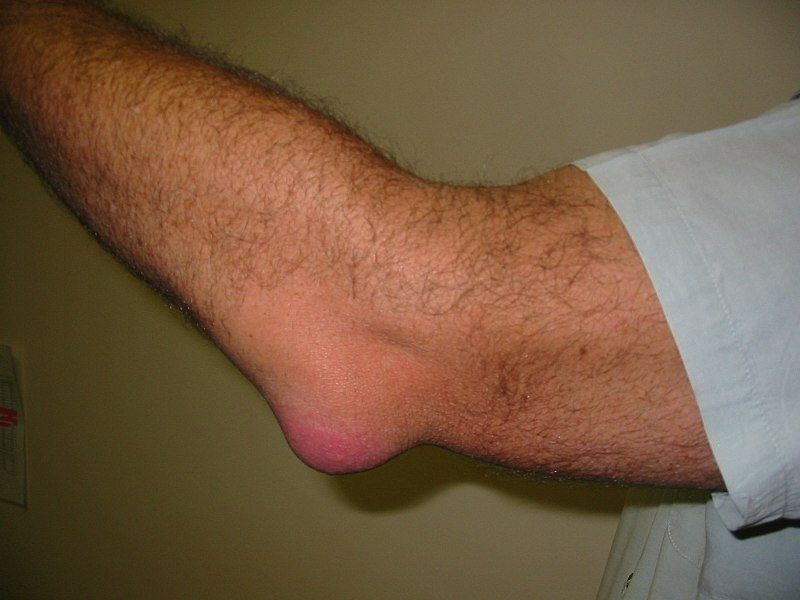 Olecranon Bursitis/Student's Elbow SimpleMed