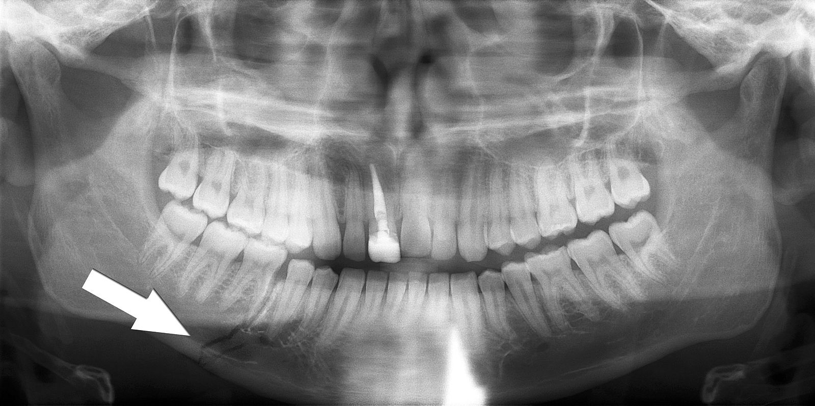 Orthopantomogram of Simple Mandible Fracture SimpleMed