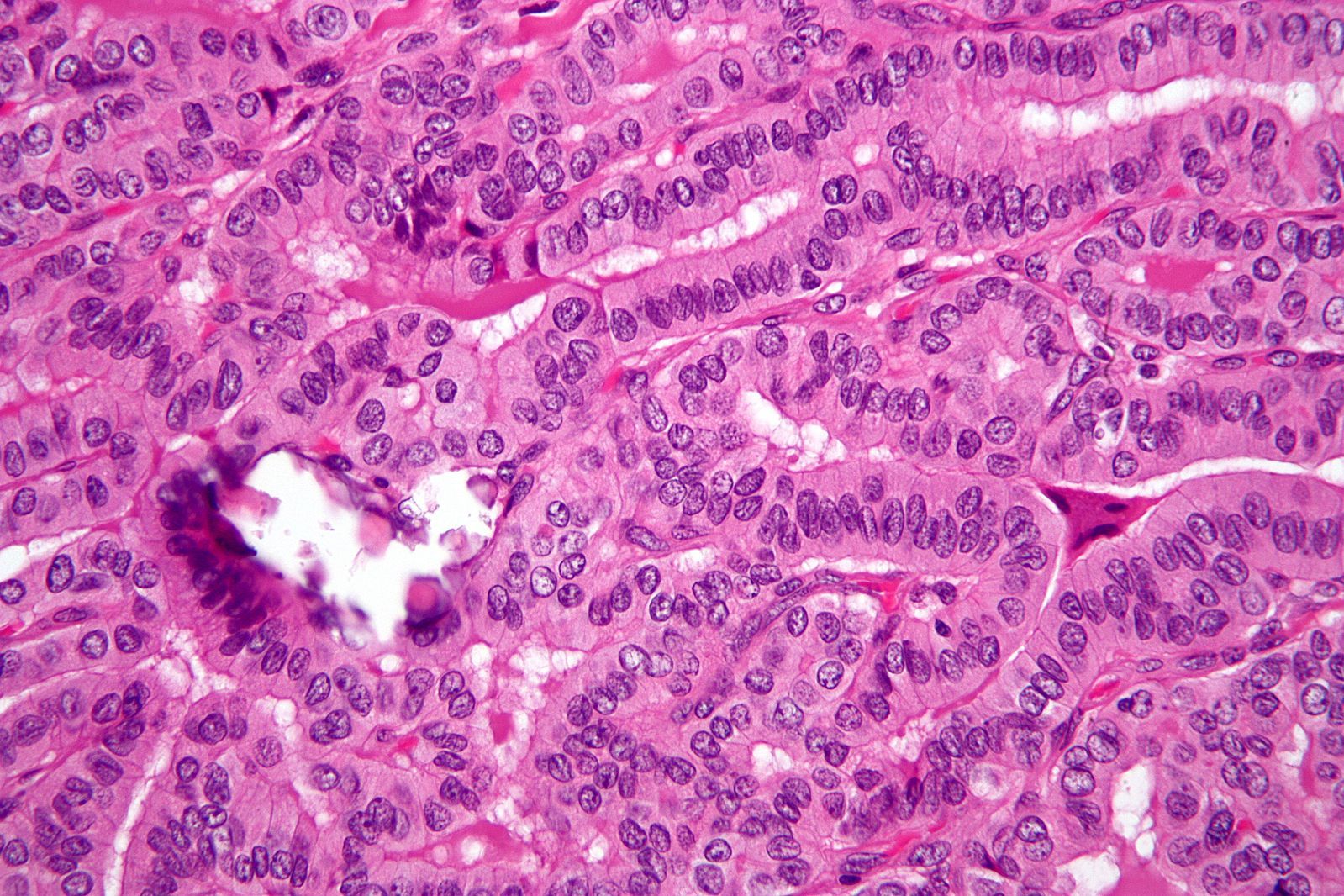 Papillary Thyroid Adenocarcinoma Histology SimpleMed